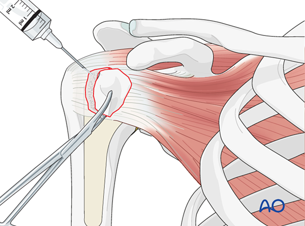 Avulsion of lesser tuberosity – the fracture bed is cleaned and any hematoma is removed