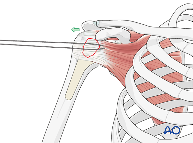 Avulsion of lesser tuberosity -reduce the greater tuberosity by pulling on the stay suture(s).