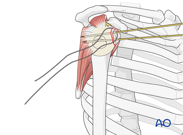 Avulsion of lesser tuberosity - temporarily secure the reduction with 1 or 2 K-wires.