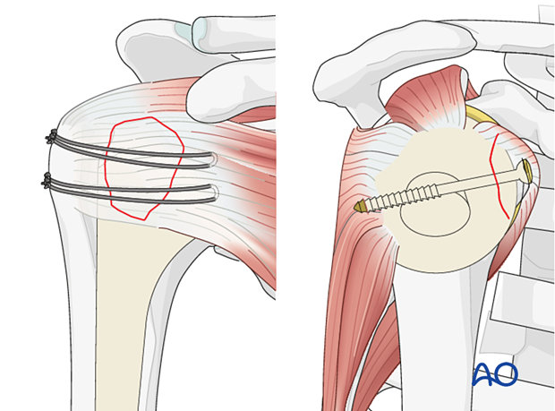 Avulsion of lesser tuberosity - fixation techniques