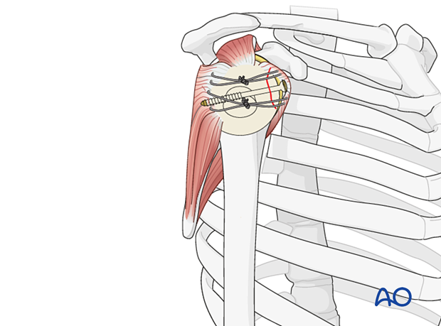 Avulsion of lesser tuberosity – combination of screw fixation and suture fixation