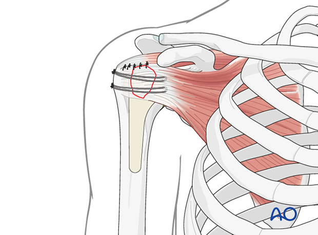 Avulsion of lesser tuberosity – repair of the rotator cuff interval