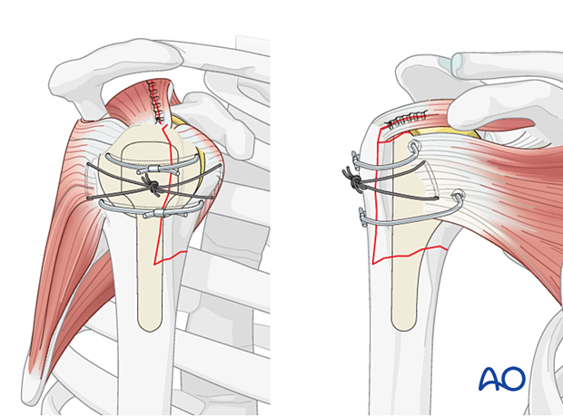 Avulsion of lesser tuberosity – suture fixation