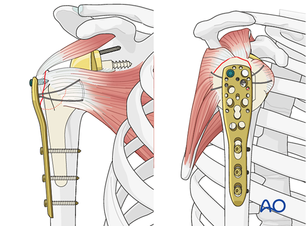 A plate can be used to buttress a greater tuberosity fragment