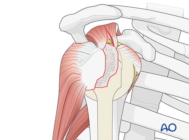 Avulsion of greater tuberosity