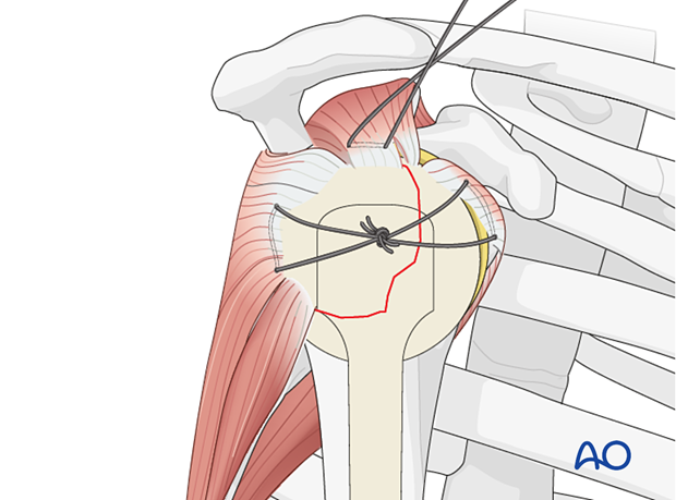 Sutures in the rotator cuff tendon insertions aid manipulation, reduction, and temporary fixation of a proximal humerus fracture.