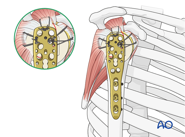 Sutures placed through the insertions of each rotator cuff tendon increase stability.