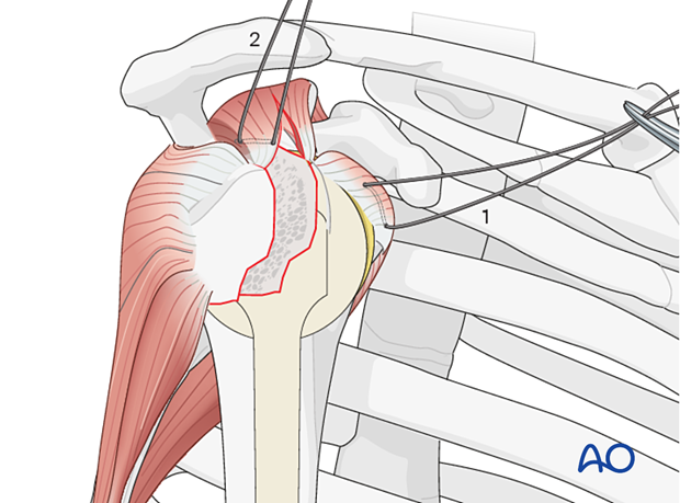 Rotator cuff sutures: Subscapularis and supraspinatus tendon