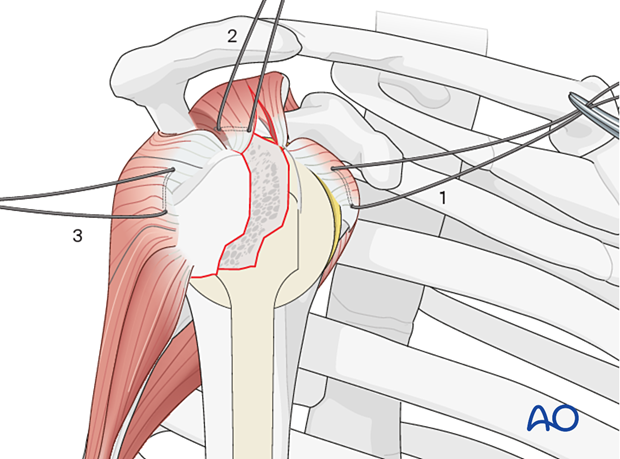 Rotator cuff sutures: subscapularis, supraspinatus, infraspinatus