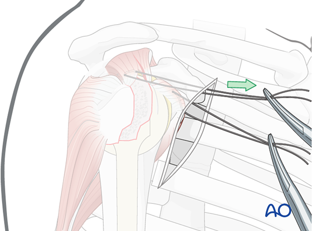 Anterior traction on the supraspinatus tendon helps expose the greater tuberosity and infraspinatus tendon.