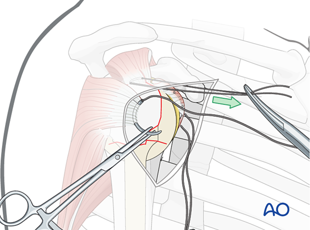 A preliminary traction suture is inserted into the visible part of the posterior rotator cuff