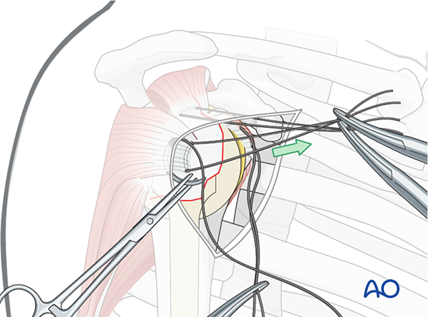 Traction on the suture exposes the proper location for a suture in the infraspinatus tendon insertion