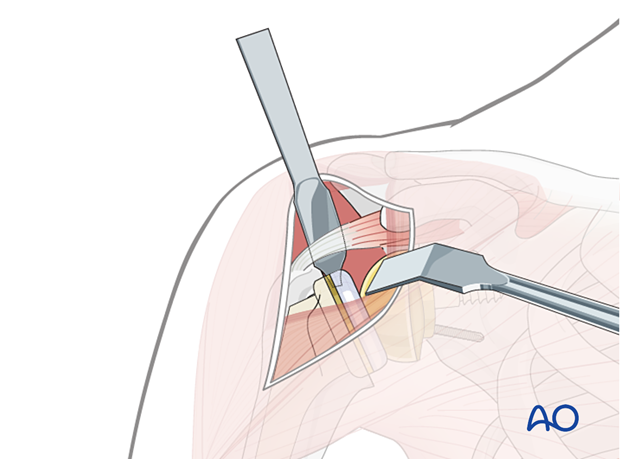 Use of a blunt, curved Hohmann retractor or deltoid retractor underneath the deltoid muscle can help to expose the proximal humerus