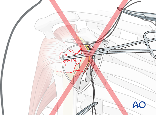 Osteoporotic bone fragments are readily damaged by forceps or clamps. This is avoided by using sutures to aid manipulation and reduction