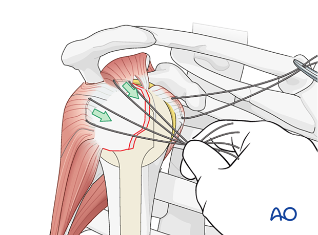 The sutures in the supraspinatus and infraspinatus tendons are used to reduce the greater tuberosity