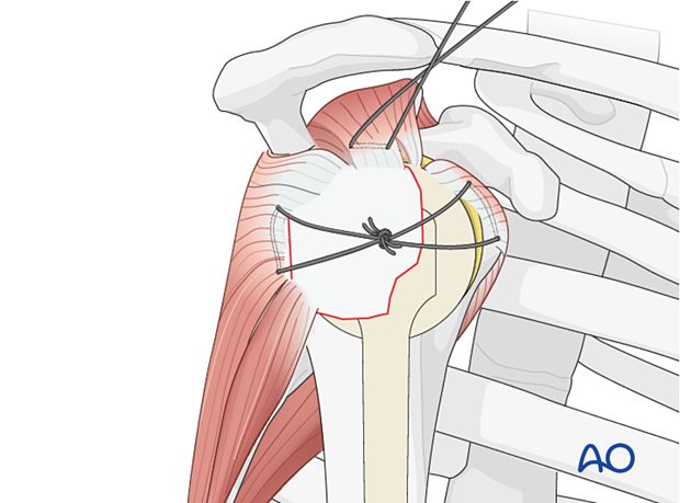 The transverse sutures are tightened and tied to achieve preliminary fixation of the greater tuberosity fragment