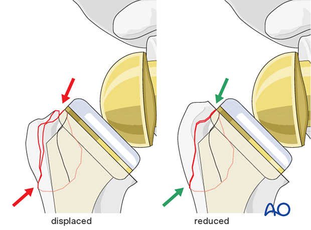 All fracture lines should remain closed without steps or gaps between the greater and lesser tuberosities during rotation of the arm