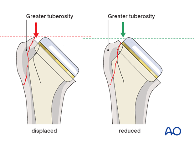 The AP x-ray should show the correct relationship between the prosthetic head and the tuberosities