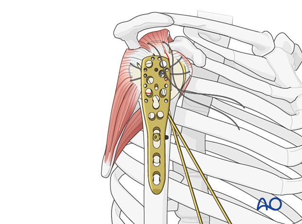 The plate is fixed to the humeral shaft