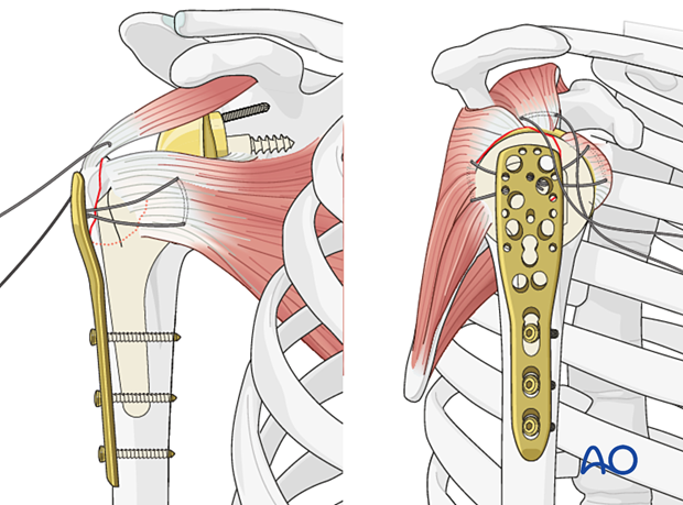 Insert one or two additional bicortical screws to fix the plate to the humeral shaft