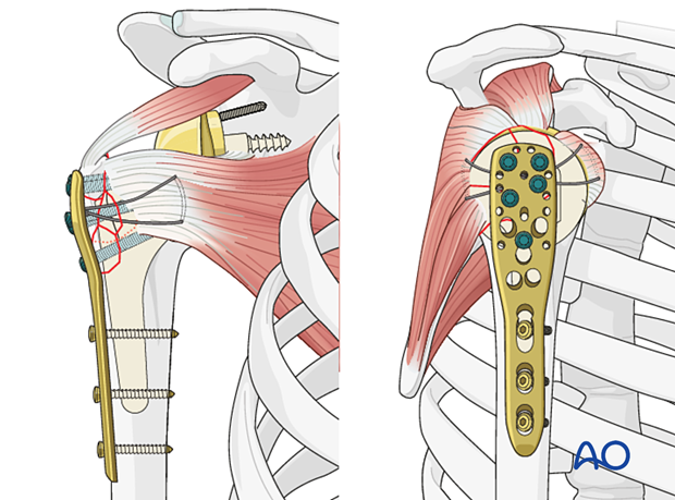 If the greater tuberosity fragment is sufficiently large, proximal angle stable screws can be inserted to increase fixation stability