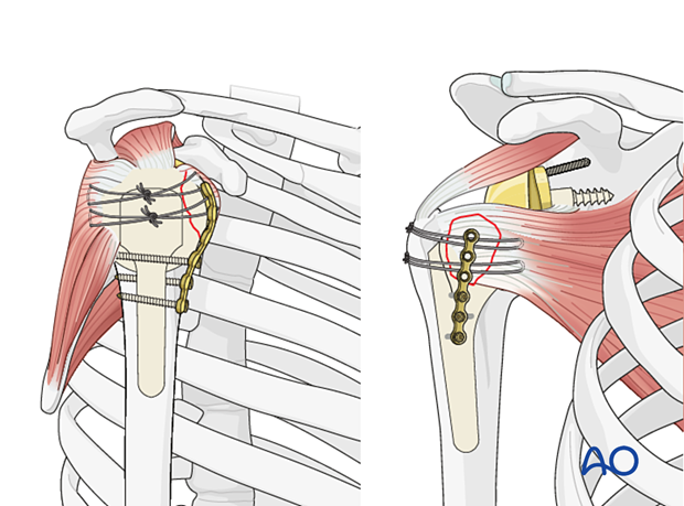 A plate can be used to buttress a lesser tuberosity fragment to increase the stability of a suture fixation