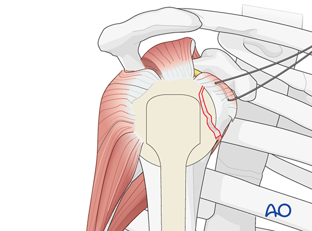 Sutures in the rotator cuff tendon insertions aid manipulation, reduction, and temporary fixation of a lesser tuberosity fracture.