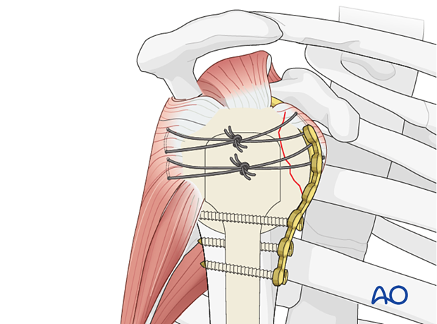 For fractures of the lesser tuberosity sutures placed through the insertions of the subscapularis tendon are the principal fixation technique