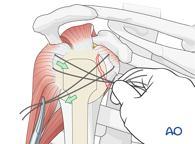 Traction on the sutures in the subscapularis tendon aids reduction of the lesser tuberosity