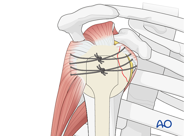 The transverse sutures are tightened and tied to achieve preliminary fixation of the lesser tuberosity fragment