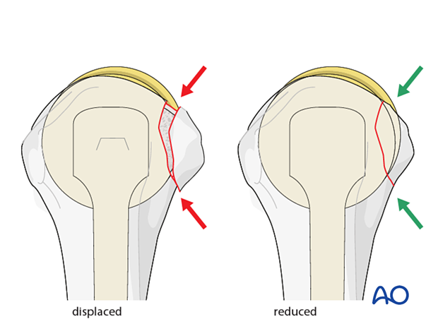 After preliminary fixation of the lesser tuberosity check the reduction visually and by image intensification.