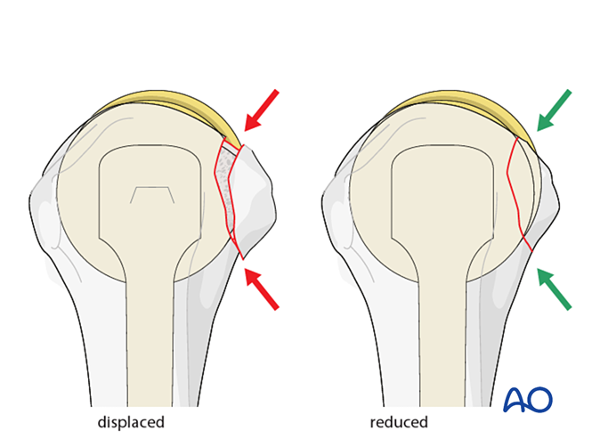 ORIF - Plate fixation for Avulsion of the lesser tuberosity