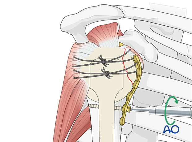 Lesser tuberosity fracture: attach the plate to the humeral shaft with a bicortical small fragment 3.5 mm screw inserted through the elongated hole.