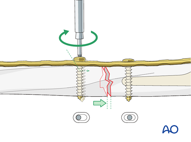 Humeral shaft periprosthetic fracture – compression plate