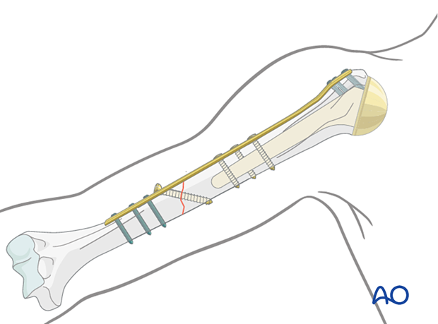 Humeral shaft periprosthetic fracture - sometimes using a longer plate that reaches the greater tuberosity region can aid insertion of proximal screws