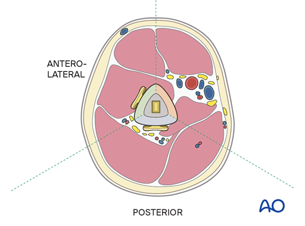 Humeral shaft periprosthetic fracture -plate positions