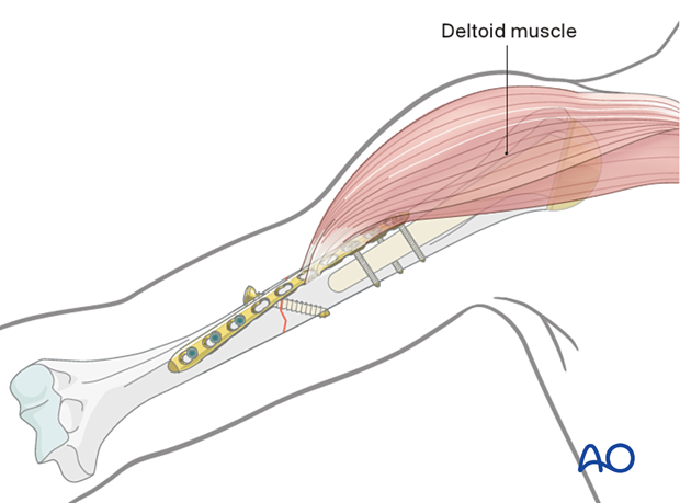 Humeral shaft periprosthetic fracture - depending on the chosen positions for the proximal and distal plate ends, the plate may need to be contoured and/or twisted