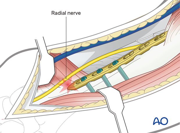 Humeral shaft periprosthetic fracture - The radial nerve is at risk if the plate is applied to the lateral surface in the distal third of the humerus