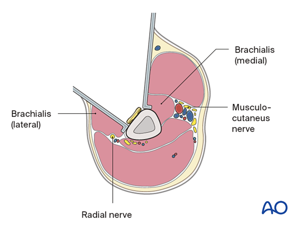 Humeral shaft periprosthetic fracture - The innervation of the brachialis muscle is derived from both the radial and musculocutaneous nerves. The radial branch is at risk if the plate is applied to the anterior and anterolateral surfaces in the distal third of the humerus while retracting the entire brachialis muscle medially