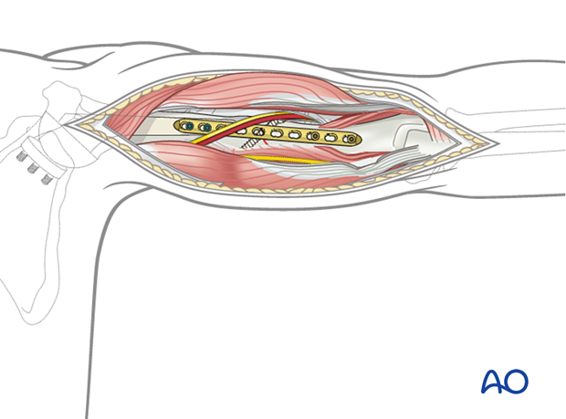 Humeral shaft periprosthetic fracture - posterior plate