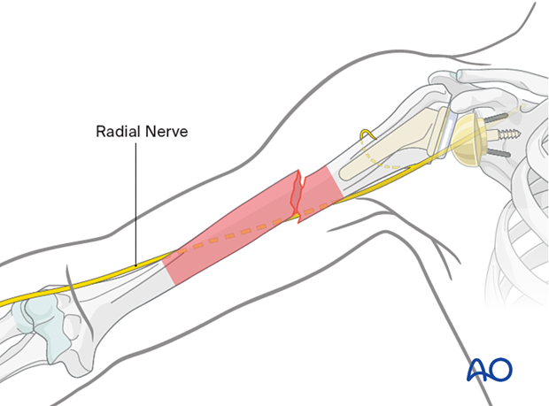 Humeral shaft periprosthetic fracture - To avoid injury to the radial nerve its trajectory in relation to the fracture should be determined before and during reduction and fixation.