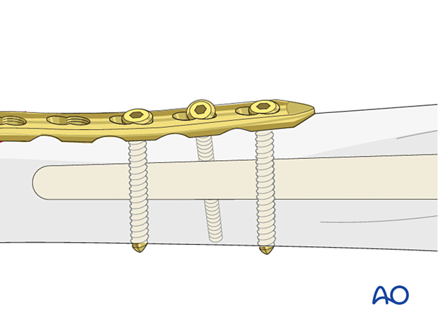 Humeral shaft periprosthetic fracture – using off-axis screws on either side of the implant