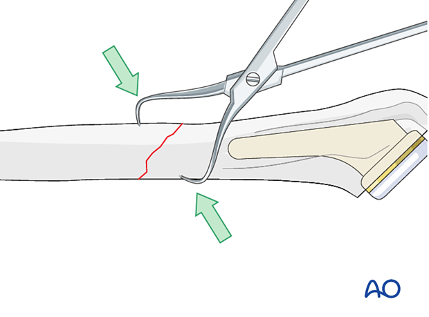 Humeral shaft periprosthetic fracture - reduction