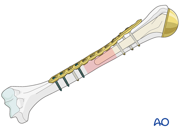 Humeral shaft periprosthetic fractures - bridge plating