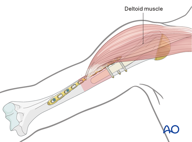 Humeral shaft periprosthetic fractures - bridge plating – the plate may need to be contoured and/or twisted.