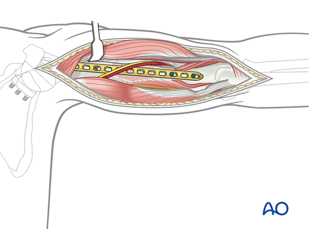 Humeral shaft periprosthetic fractures - bridge plating – Posterior plate