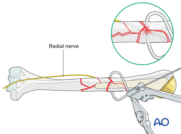 Humeral shaft periprosthetic fractures - bridge plating – comminuted fragments