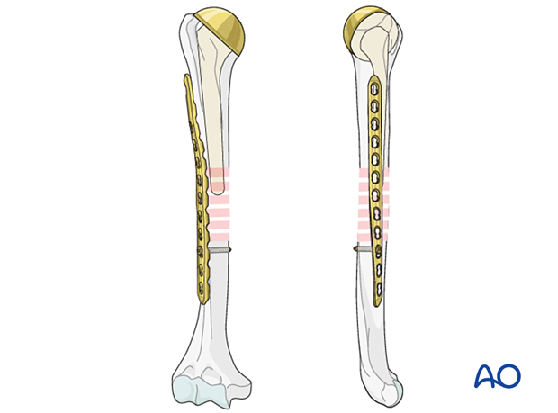 Humeral shaft periprosthetic fractures - bridge plating – plate application