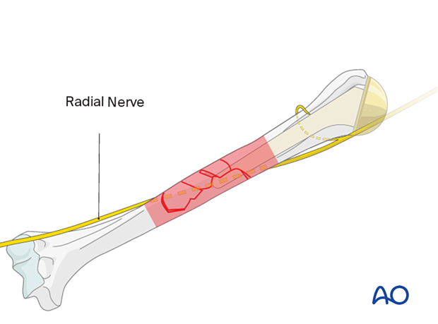 Humeral shaft periprosthetic fractures - bridge plating – to avoid injury to the radial nerve its trajectory in relation to the fracture should be determined before and during reduction and fixation