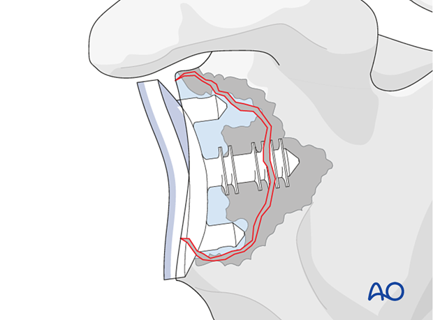 An anatomic all polyethylene glenoid component